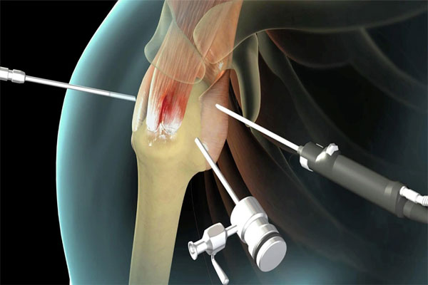 Best Knee Ligament Repair In Jaipur